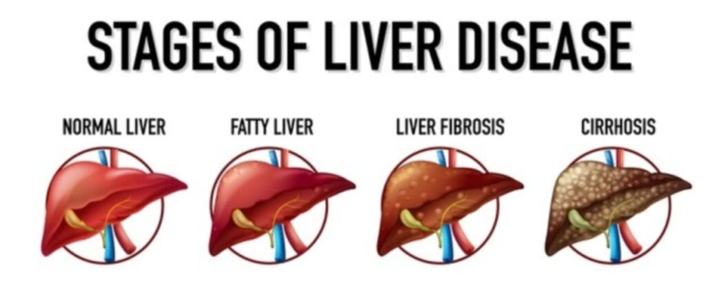 Fatty liver