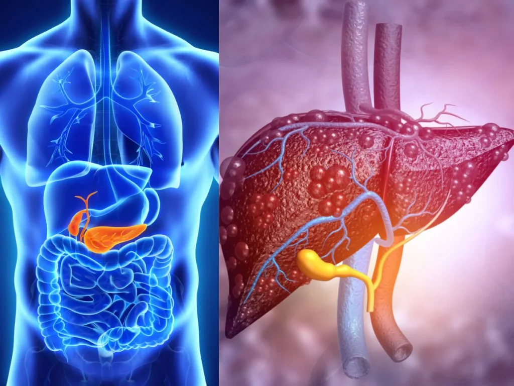 फैटी लिवर