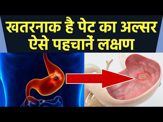 पेट में अल्सर